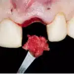 Milloin verihyytymä irtoaa hampaan poiston jälkeen